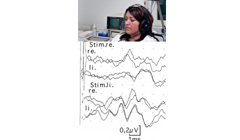 AEP (acoustically evoked potentials)