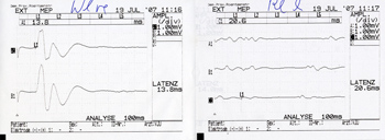MEP (magnetic-evoked potentials)