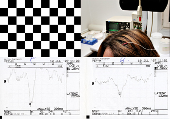 VEP – visually evoked potentials