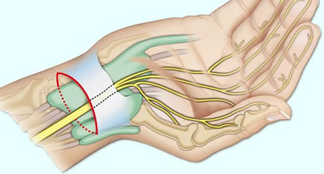 carpal tunnel syndrome, Dubai