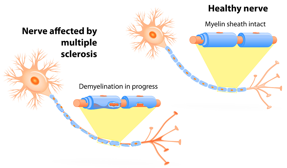 Multiple Sclerosis, MS, Dubai