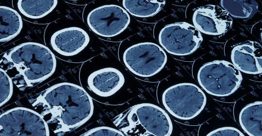 Breakthrough: New Multiple Sclerosis MS Treatment With Old Drug