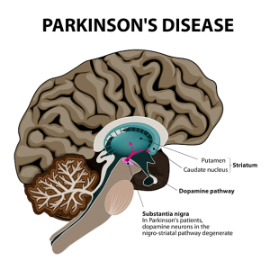 Parkinson uae
