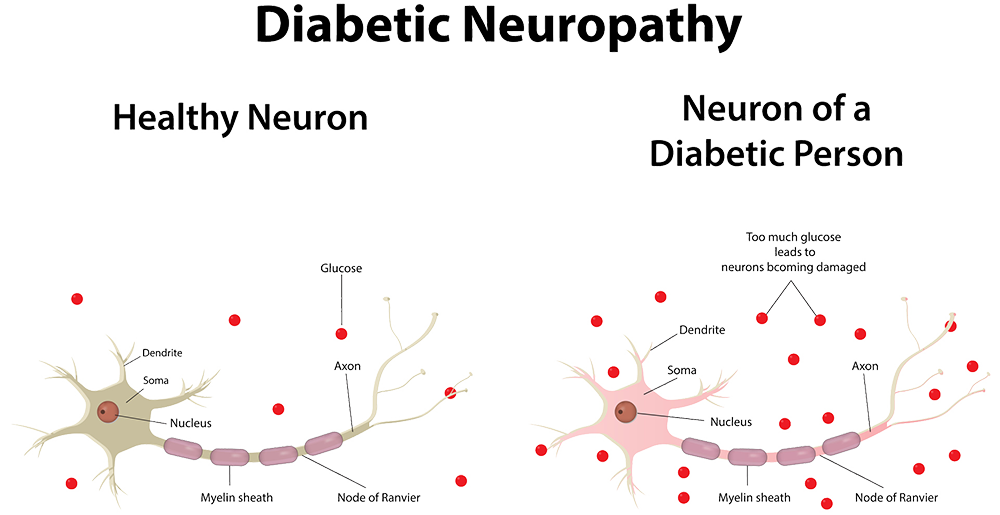 diabetic neuropathy dubai
