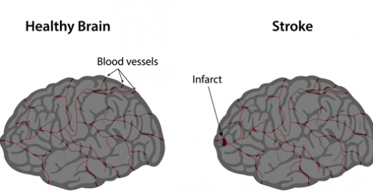 Stroke in Dubai – Ask Your Doctor