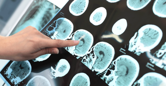 81% of Multiple Sclerosis sufferers are misdiagnosed by GP, study reveals