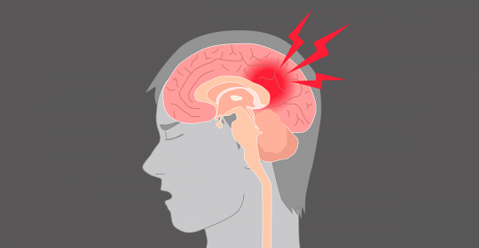Strokes rate sharply increased in younger people (35 -54 years)
