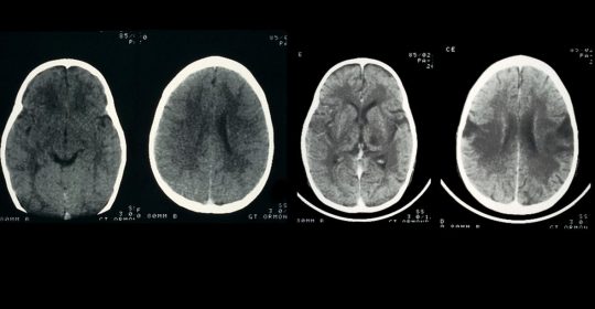 Differences between Meningitis and Encephalitis