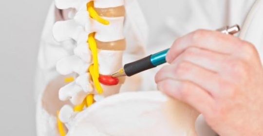 Slipped Disc: Symptoms, Causes & Effects