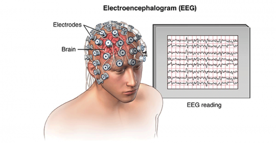 EEG – Electroencephalography